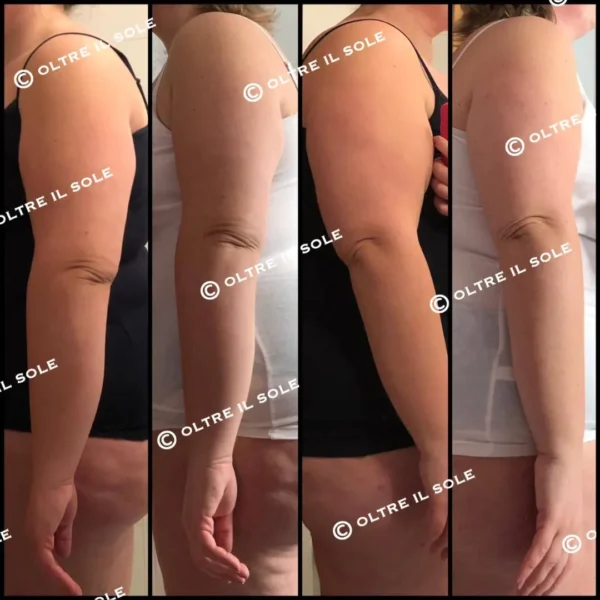 benda snellente braccia