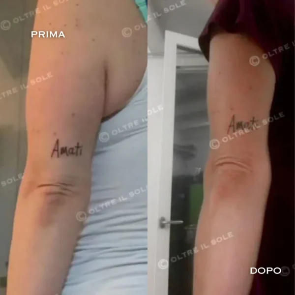 benda snellente braccia