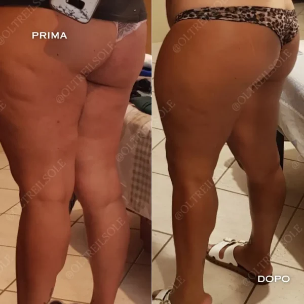 bende drenanti anticellulite